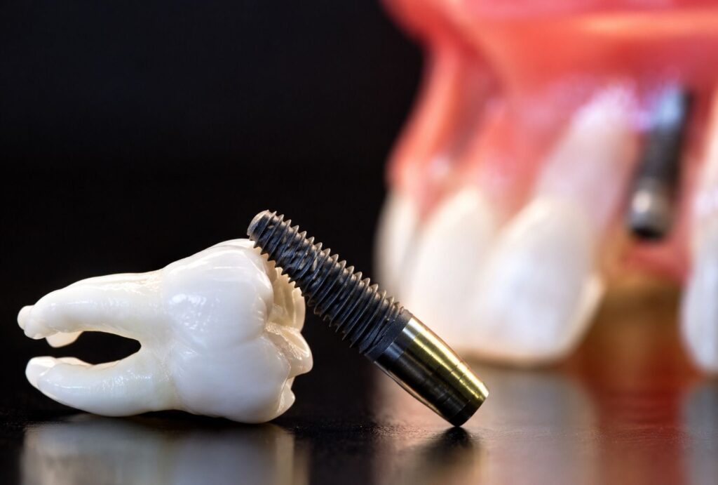 Implantes